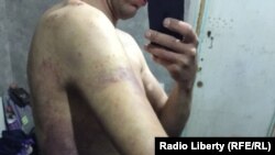 Олексій у записі скайпом показує синці після побиття російськими військовими, які незаконно його захопили і утримували. 25 березня 2022 року