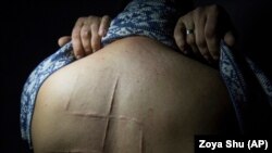 Колишній заручник угруповання «ДНР» Богдан Сергієць показує шрами, які залишились після того, як бойовики російських гібридних сил вирізали свастику на його спині. Світлина 2019 року із фотопроєкту Зої Шу «Після полону»